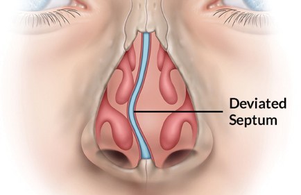 Image of deviated septum from otolaryngologist.