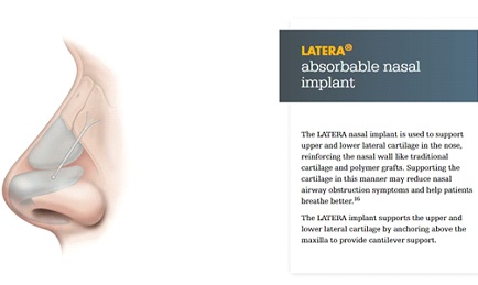 Model showing positioning of implant to open the nose.