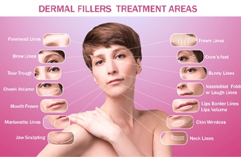 Diagram showing potential treatment areas for facial fillers