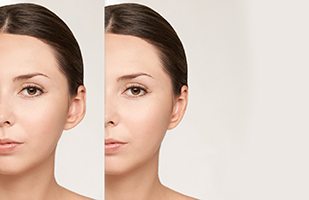 Side of woman’s face before and after otoplasty surgery