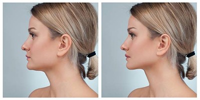 Before and after rhinoplasty