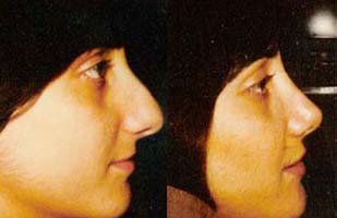 Woman’s facial profile before and after rhinoplasty surgery