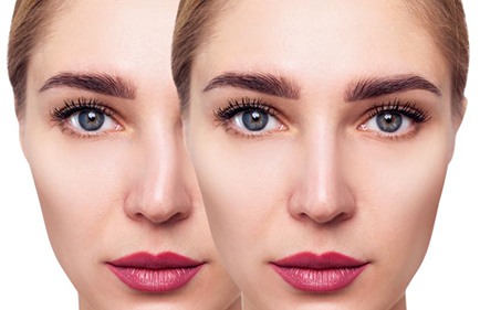 Face of woman before and after septoplasty