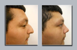 Before and after rhinoplasty