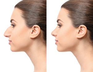 before and after rhinoplasty