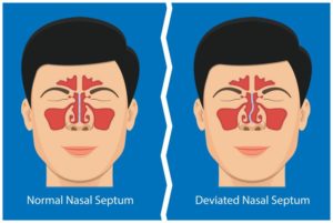 Illustration comparing normal vs. deviated nasal septum