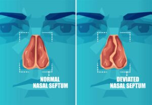 Diagram showing normal vs. deviated nasal septum 