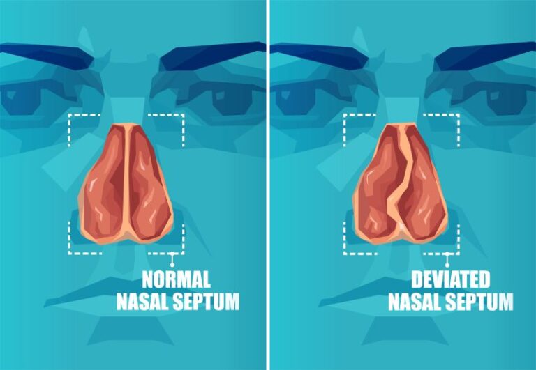 Beyond Breathing Problems: The Complications of a Severely Deviated Septum